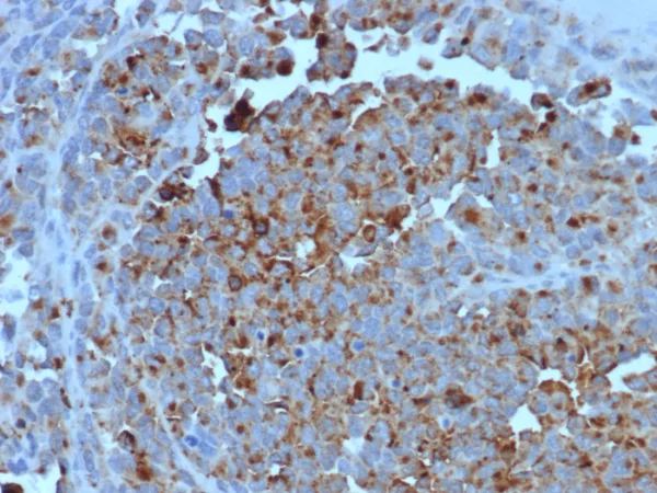 Formalin-fixed, paraffin-embedded human melanoma stained with CD63 Mouse Monoclonal Antibody (LAMP3/7369). HIER: Tris/EDTA, pH9.0, 45min. 2°C: HRP-polymer, 30min. DAB, 5min.