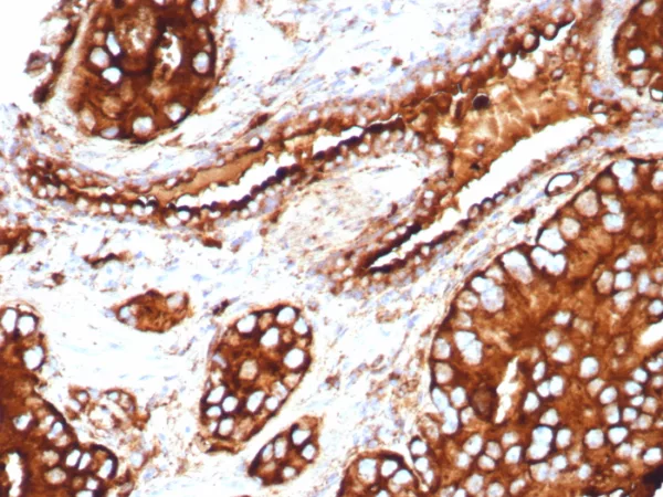 Formalin-fixed, paraffin-embedded human prostate stained with CD63 Recombinant Rabbit Monoclonal Antibody (LAMP3/8705R). HIER: Tris/EDTA, pH9.0, 45min. 2: HRP-polymer, 30min. DAB, 5min.