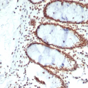 Formalin-fixed, paraffin-embedded human colon carcinoma stained with CDC5L Mouse Monoclonal Antibody (PCRP-CDC5L-2C6). HIER: Tris/EDTA, pH9.0, 45min. 2°C: HRP-polymer, 30min. DAB, 5min.