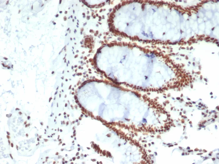 Formalin-fixed, paraffin-embedded human colon carcinoma stained with CDC5L Mouse Monoclonal Antibody (PCRP-CDC5L-2C6). HIER: Tris/EDTA, pH9.0, 45min. 2°C: HRP-polymer, 30min. DAB, 5min. CDC5L Antibody