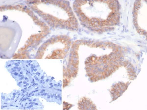 Formalin-fixed, paraffin-embedded human prostate carcinoma stained with E-Cadherin Mouse Recombinant Monoclonal Antibody (rCDH1/7352). Inset: PBS instead of primary antibody; secondary only negative control.