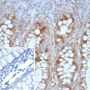 Formalin-fixed, paraffin-embedded human colon carcinoma stained with E-Cadherin Rabbit Recombinant Monoclonal Antibody (CDH1/9226R). Inset: PBS instead of primary antibody; secondary only negative control.