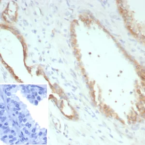 Formalin-fixed, paraffin-embedded human prostate carcinoma stained with Pan-Cadherin Mouse Monoclonal Antibody (Pan-CAD/8019). Inset: PBS instead of primary antibody; secondary only negative control.