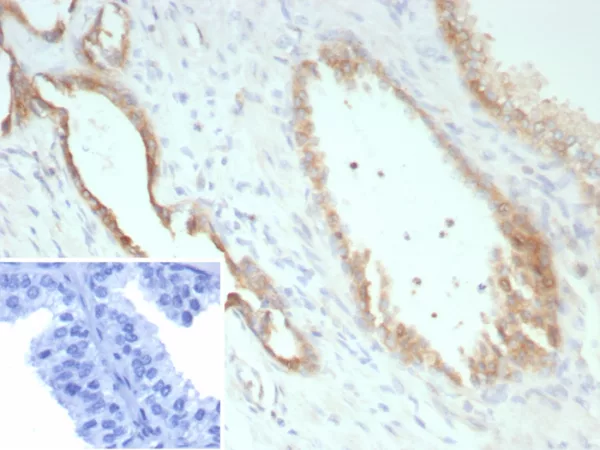 Formalin-fixed, paraffin-embedded human prostate carcinoma stained with Pan-Cadherin Mouse Monoclonal Antibody (Pan-CAD/8019). Inset: PBS instead of primary antibody; secondary only negative control.