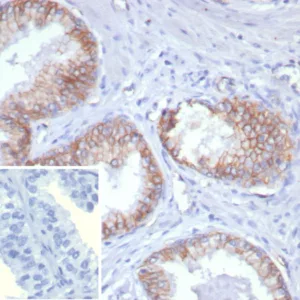 Formalin-fixed, paraffin-embedded human prostate carcinoma stained with Pan-Cadherin Mouse Monoclonal Antibody (Pan-CAD/8020). Inset: PBS instead of primary antibody; secondary only negative control.