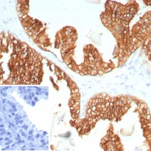 Formalin-fixed, paraffin-embedded human prostate carcinoma stained with Cytokeratin 5/6 Mouse Monoclonal Antibody (KRT5.6/9104). Inset: PBS instead of primary antibody; secondary only negative control.
