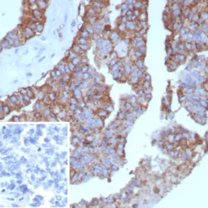 Formalin-fixed, paraffin-embedded human ovarian cancer stained with HLA-Pan Recombinant Mouse Monoclonal Antibody (rHLA-Pan/8847). Inset: PBS instead of primary, secondary negative control.