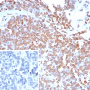 Formalin-fixed, paraffin-embedded human ovarian cancer stained with dsDNA Recombinant Mouse Monoclonal Antibody (rDSD/8266). Inset: PBS instead of primary antibody; secondary only negative control.