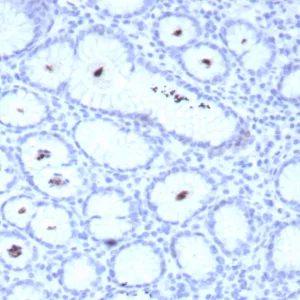 Formalin-fixed, paraffin-embedded human H. pylori-infected stomach stained with H. pylori Recombinant Rabbit Monoclonal Antibody (HPYL/8548R). HIER: Tris/EDTA, pH9.0, 45min. 2°C: HRP-polymer, 30min. DAB, 5min.