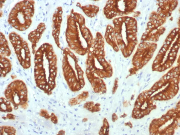 Formalin-fixed, paraffin-embedded human prostate carcinoma stained with  CK Type I Recombinant Rabbit Monoclonal Antibody (KRTL/7784R). HIER: Tris/EDTA, pH9.0, 45min. 2°C: HRP-polymer, 30min. DAB, 5min.