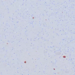 Formalin-fixed, paraffin-embedded human HSV-infected tissue stained with HSV1 Recombinant Rabbit Monoclonal Antibody (HSVI/8375R). HIER: Tris/EDTA, pH9.0, 45min. 2: HRP-polymer, 30min. DAB, 5min.