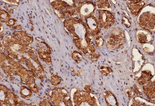 Formalin-fixed, paraffin-embedded human prostate carcinoma stained with Cytokeratin, pan Rabbit MonoPoly Antibody (MonoPoly/4999R).
