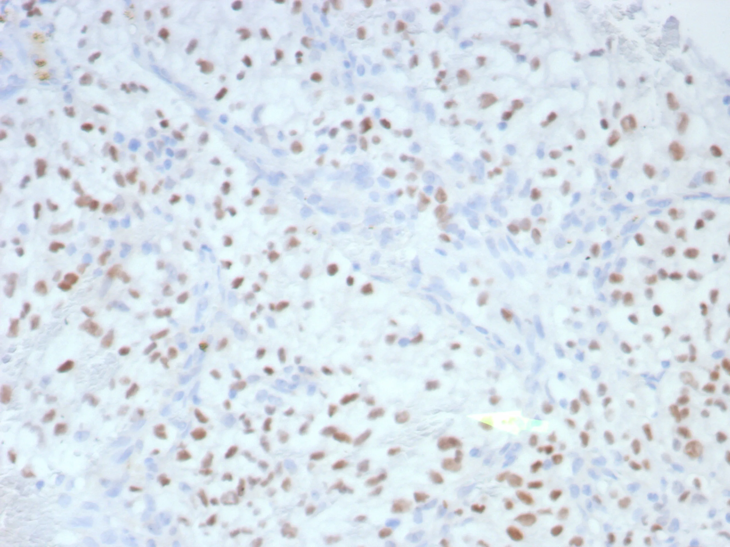 Formalin-fixed, paraffin-embedded human renal cell carcinoma stained with
PAX2 Recombinant Mouse Monoclonal Antibody (rPAX2/8506).
HIER: Tris/EDTA, pH9.0, 45min. 2°: HRP-polymer, 30min. DAB, 5min. PAX2 Antibody in Immunohistochemistry (IHC (P))