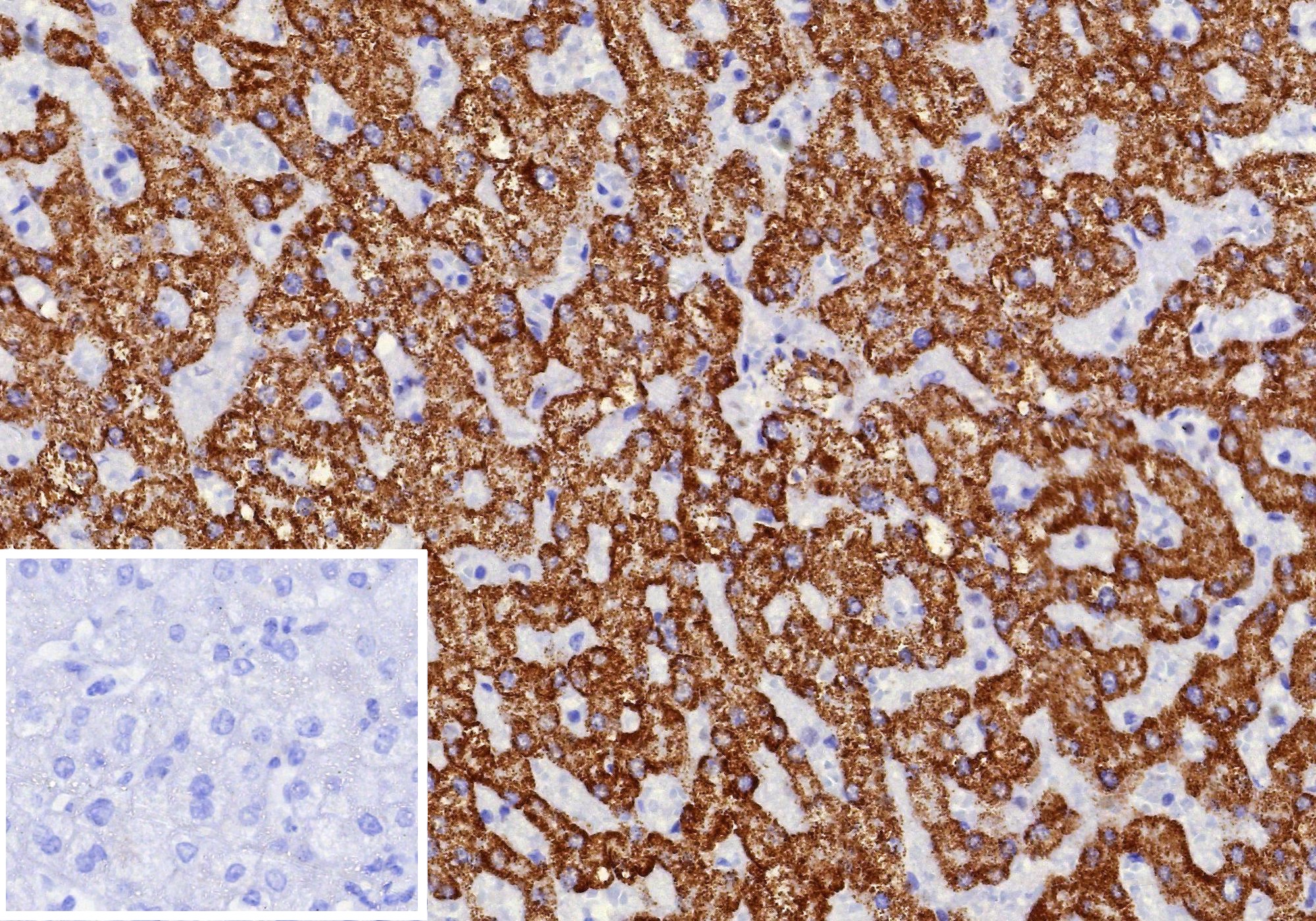 Formalin-fixed, paraffin-embedded human hepatocellular carcinoma stained with CPS1 Mouse Monoclonal Antibody (CPS1/9870). Inset: PBS instead of primary antibody; secondary only negative control. CPS1 Antibody in Immunohistochemistry (IHC (P))