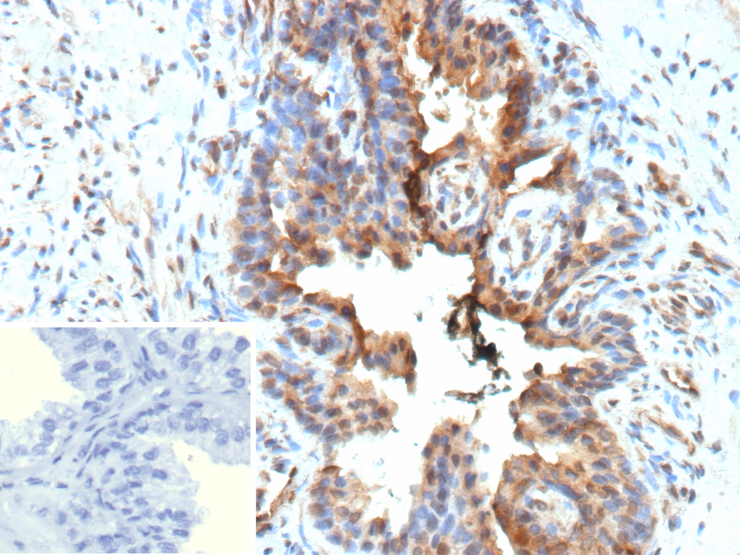Formalin-fixed, paraffin-embedded human prostate stained with
Galectin-3 Recombinant Rabbit Monoclonal Antibody (LGALS3/13208R).
Inset: PBS instead of primary antibody; secondary only negative control. Galectin-3 Antibody in Immunohistochemistry (IHC (P))