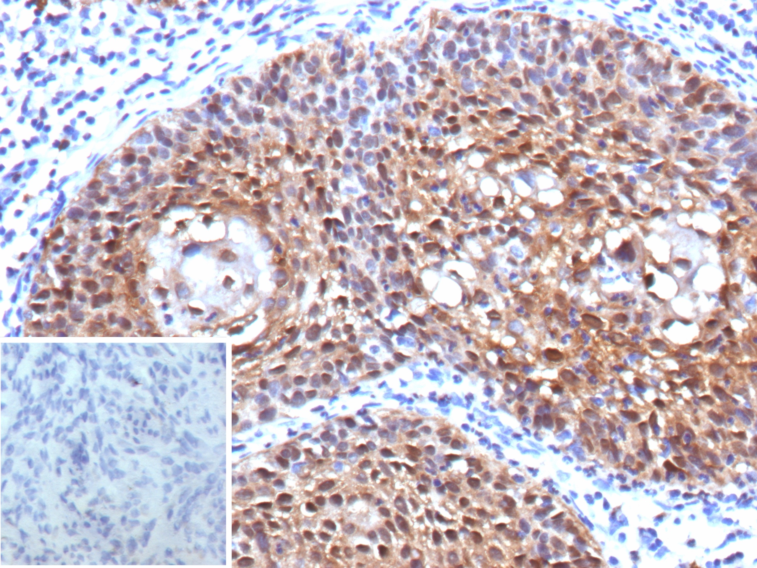 Formalin-fixed, paraffin-embedded human cervix stained with p16INK4a Recombinant Mouse Monoclonal Antibody (rCDKN2A/13303). Inset: PBS instead of primary antibody; secondary only negative control. P16INK4a / rCDKN2A Antibody in Immunohistochemistry (IHC (P))