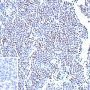 Formalin-fixed, paraffin-embedded human mantle cell lymphoma stained with SOX11 Recombinant Rabbit Monoclonal Antibody (SOX11/12966R). Inset: PBS instead of primary antibody; secondary only negative control. SOX11 Antibody in Immunohistochemistry (IHC (P))