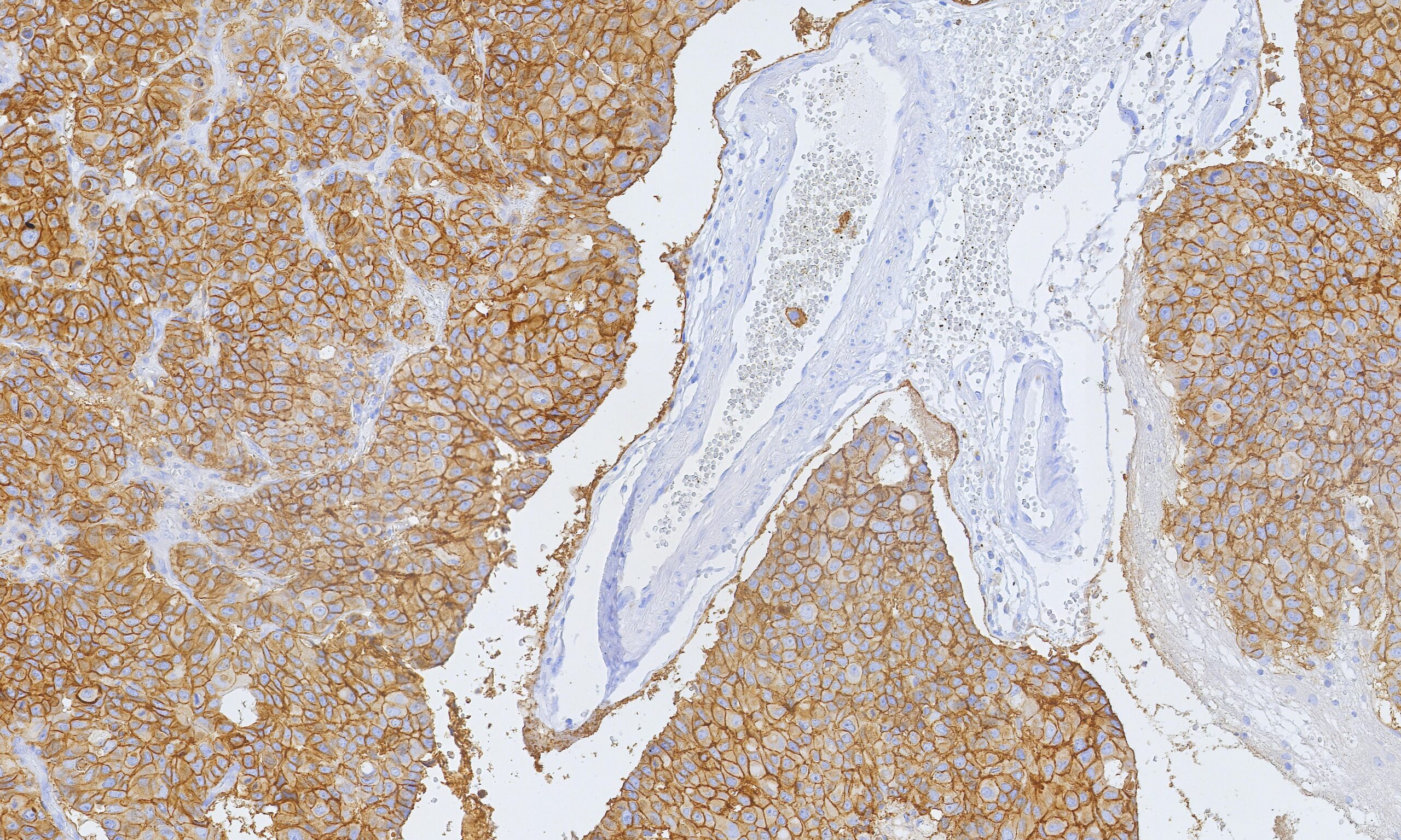 Formalin-fixed, paraffin-embedded human breast carcinoma stained with EpCAM Recombinant Rabbit Monoclonal Antibody (EGP40/9960R). Inset: PBS instead of primary antibody; secondary only negative control. HIER: Tris/EDTA, pH9.0, 45min. 2°: HRP-polymer, 30min. DAB, 5min. EpCAM Antibody in Immunohistochemistry (IHC (P))