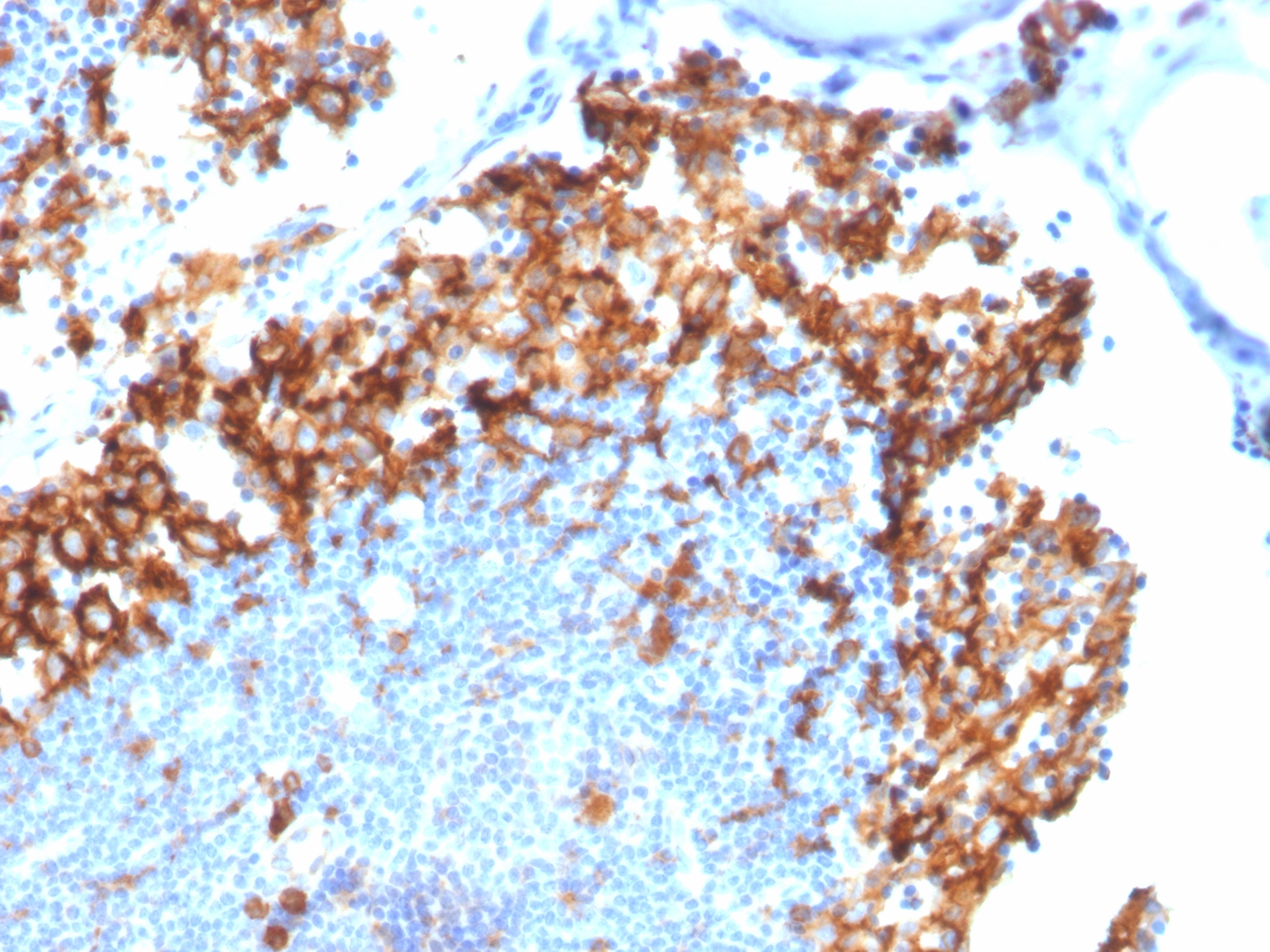 Formalin-fixed, paraffin-embedded human lymph node stained with IL3RA / CD123 Mouse Monoclonal Antibody (IL3RA/1531). Inset: PBS instead of primary antibody; secondary only negative control. IL3RA Antibody in Immunohistochemistry (IHC (P))
