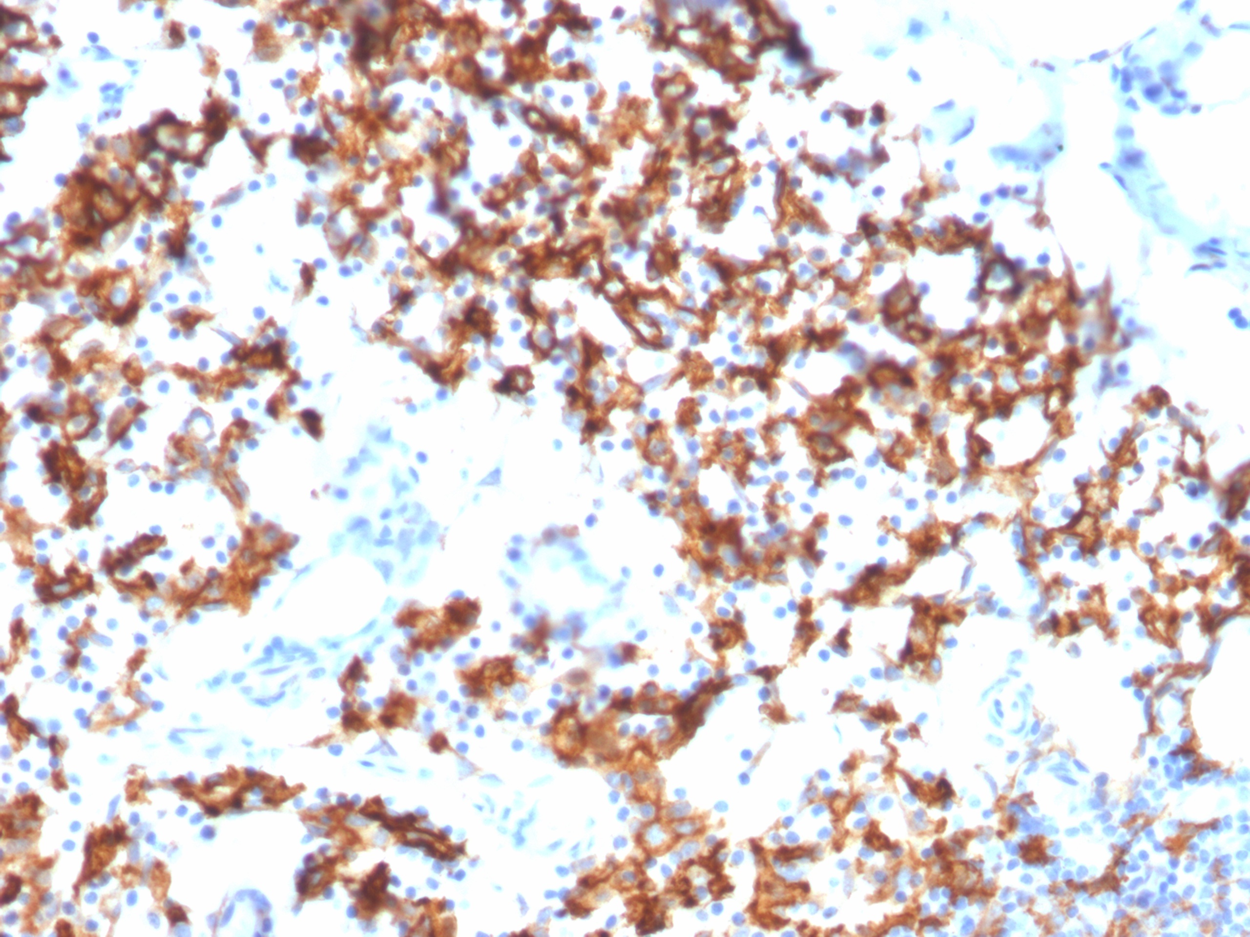 Formalin-fixed, paraffin-embedded human stomach stained with IL3RA / CD123 Mouse Monoclonal Antibody (IL3RA/1531). Inset: PBS instead of primary antibody; secondary only negative control. IL3RA Antibody in Immunohistochemistry (IHC (P))
