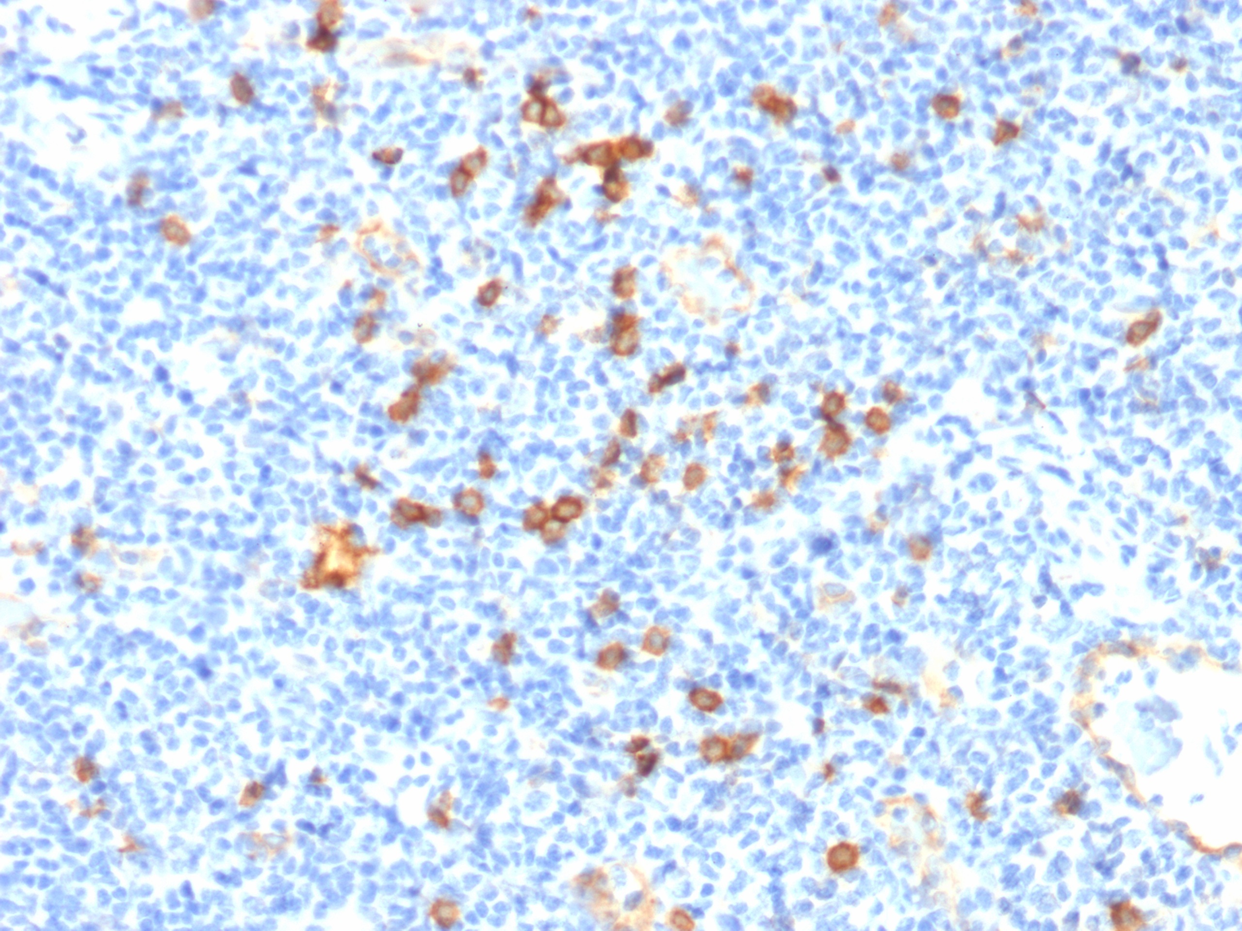 Formalin-fixed, paraffin-embedded human tonsil stained with IL3RA / CD123 Mouse Monoclonal Antibody (IL3RA/1531). Inset: PBS instead of primary antibody; secondary only negative control. IL3RA Antibody in Immunohistochemistry (IHC (P))